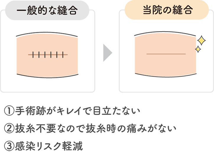 一般的な縫合と当院の縫合